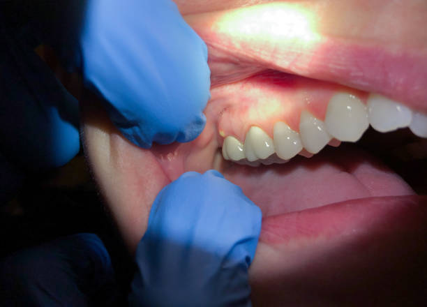 Best Emergency Gum Treatment in West Sayville, NY